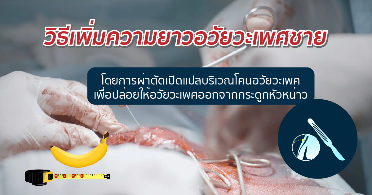 เพิ่มความยาวอวัยวะเพศชาย